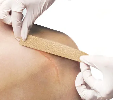 Silicone Scar Sheet